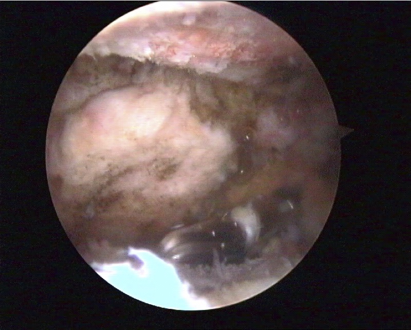 Articulation acromio-claviculaire arthrosique
