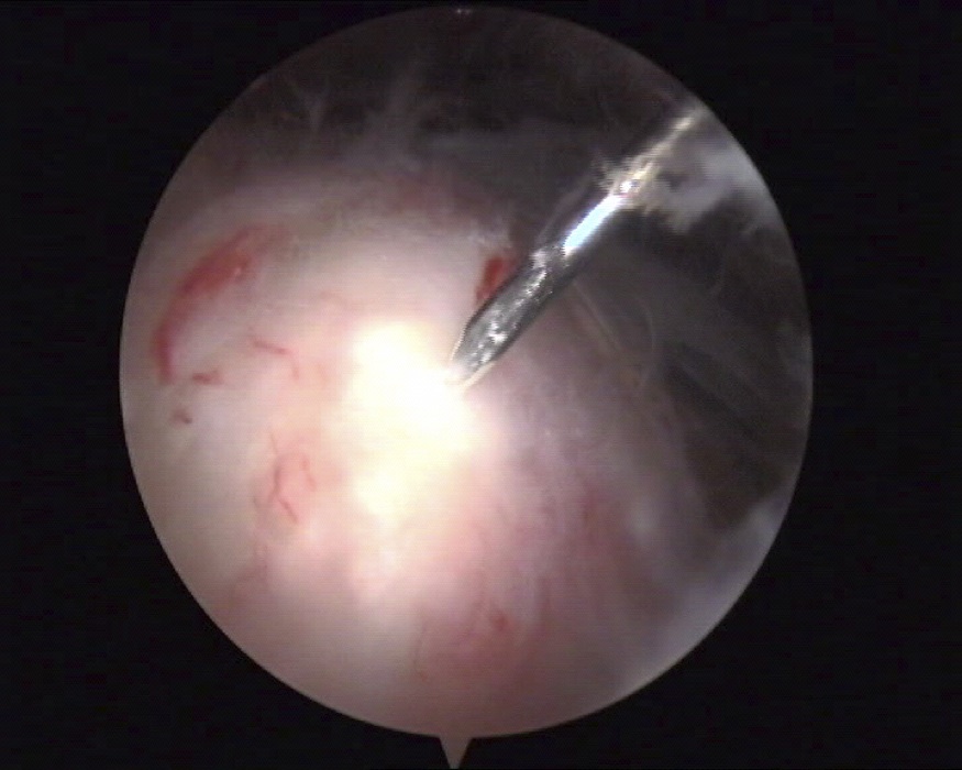 tendinopathie calcifiante