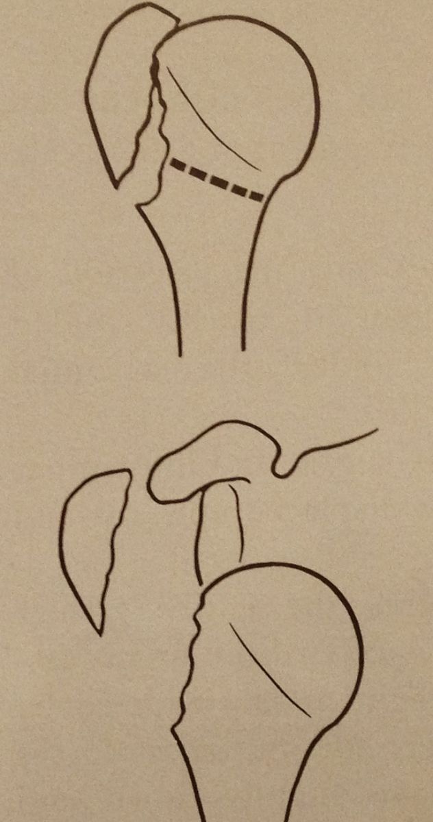 Fractures de l’Humérus