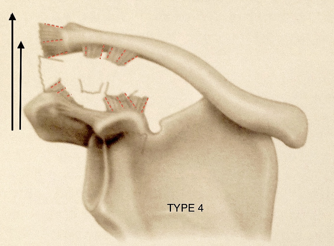 Disjonctions acromio-claviculaires