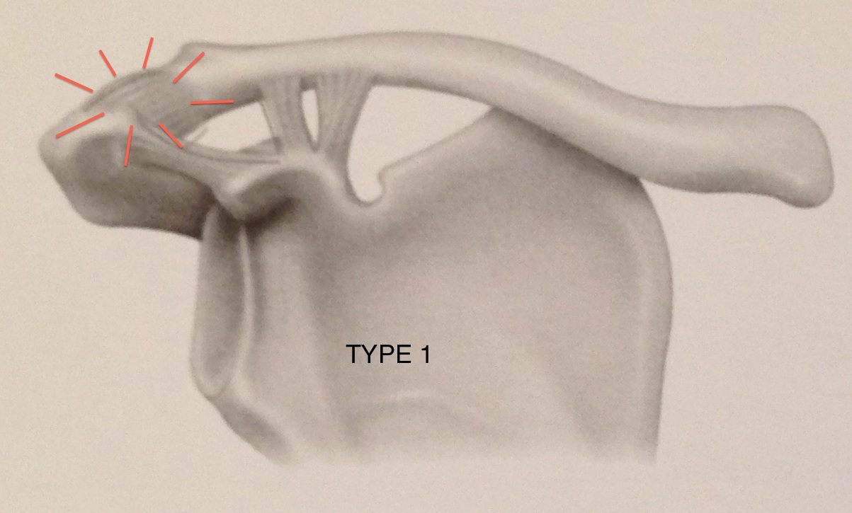 Disjonctions acromio-claviculaires