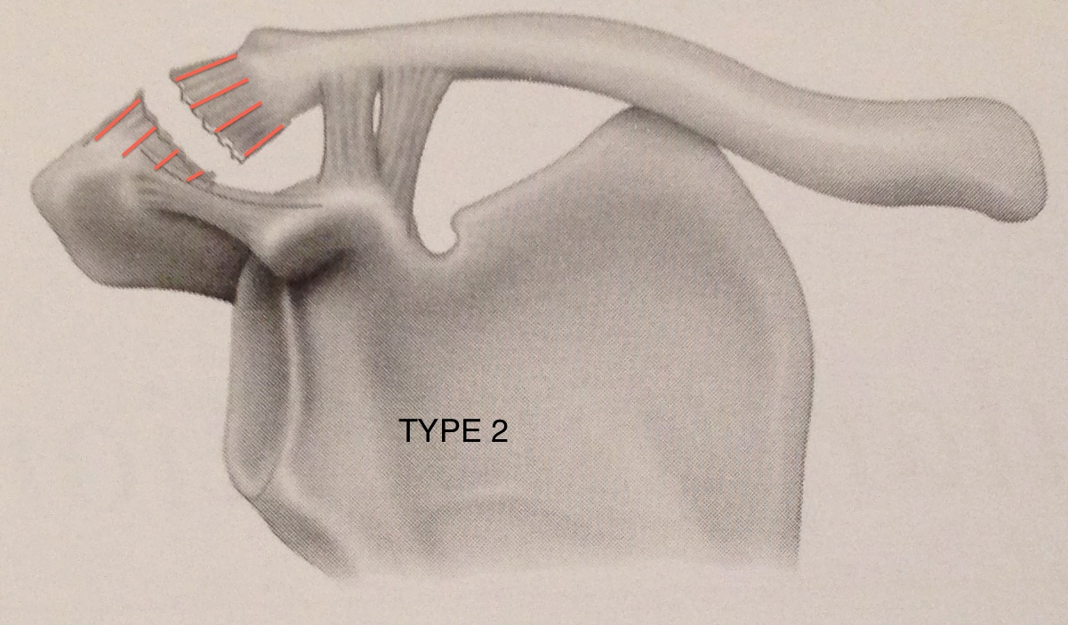 Disjonctions acromio-claviculaires