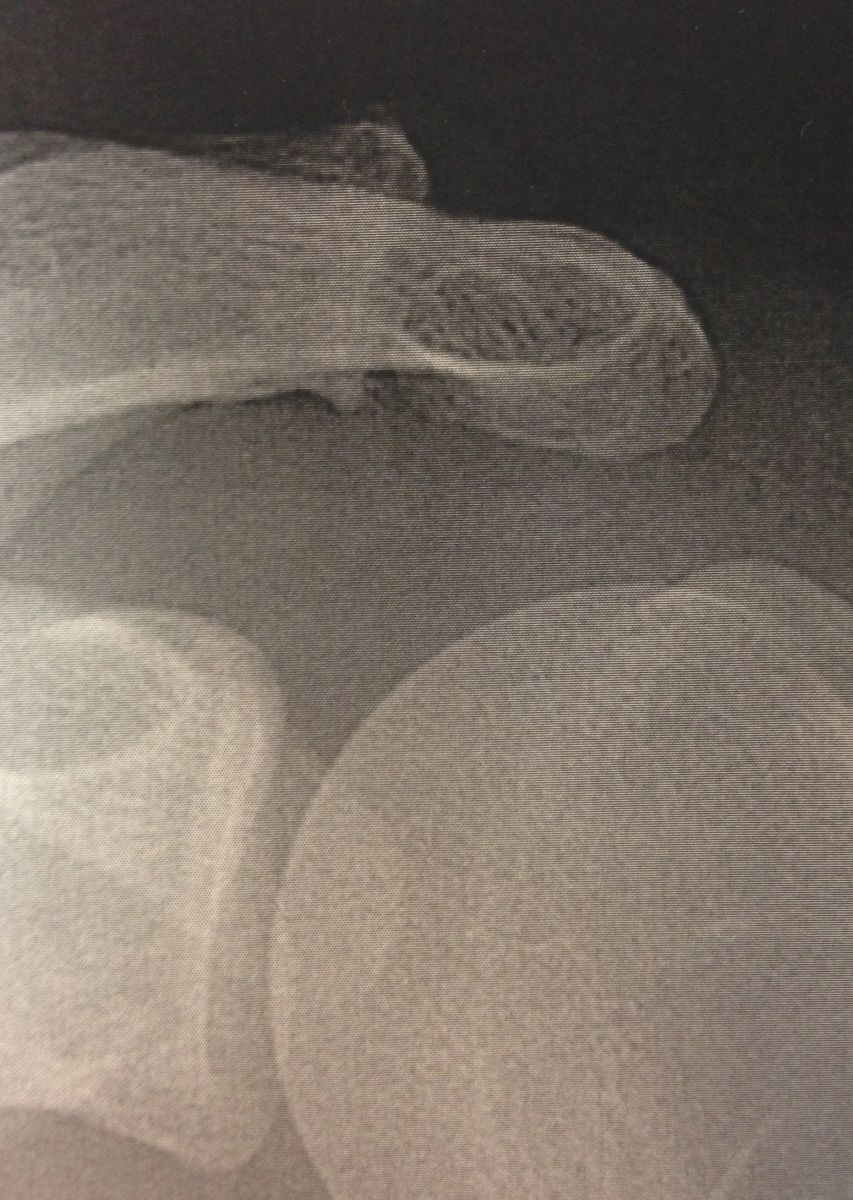 Arthrose acromio-claviculaire