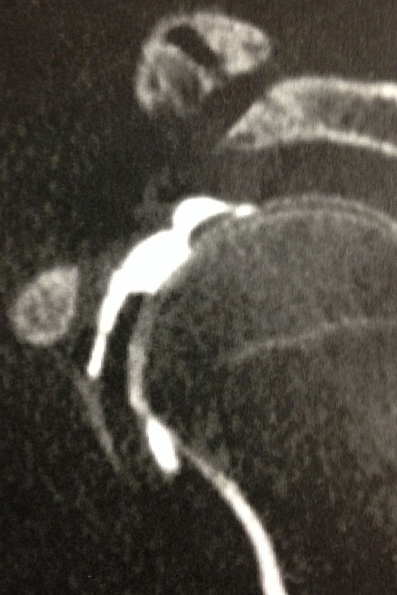 Arthrose acromio-claviculaire