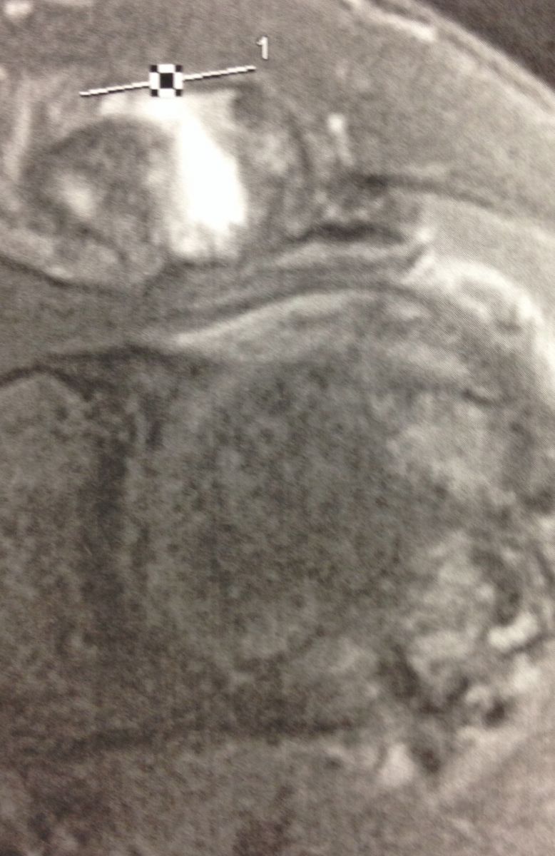Arthrose acromio-claviculaire