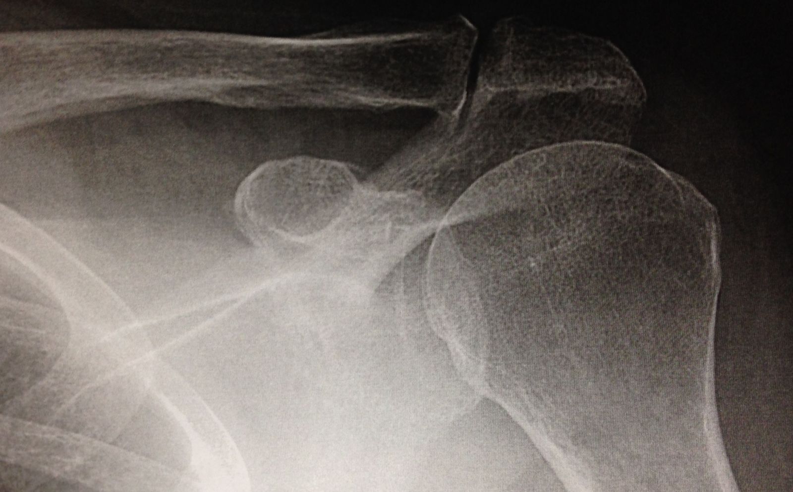 Arthrose acromio-claviculaire