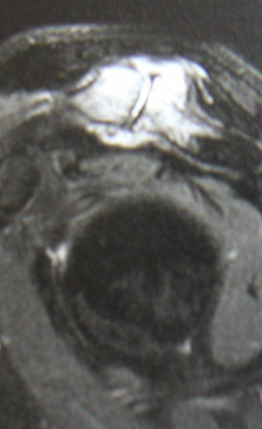 Arthrose acromio-claviculaire