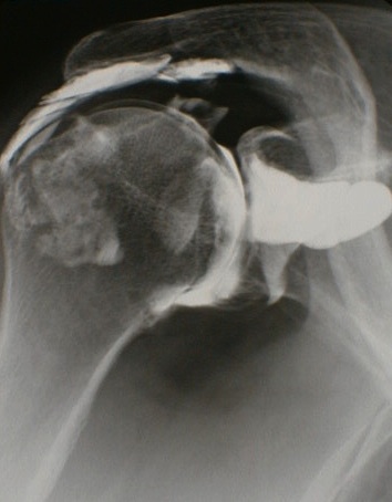 rupture de coiffe