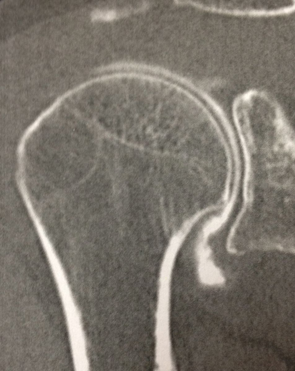 Examens de l'épaule : arthro-scanner