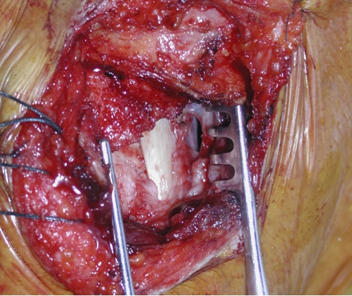 chirurgie de l'épaule ciel ouvert
