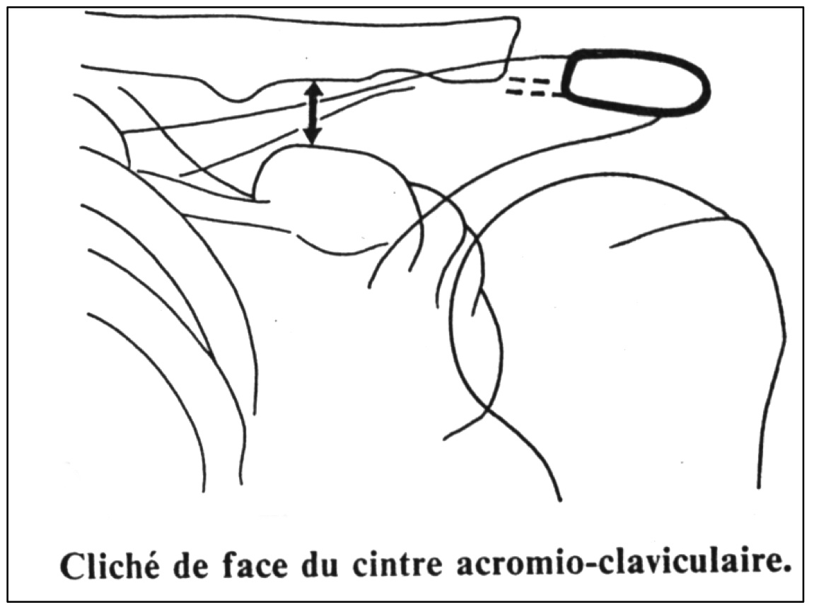 Disjonctions acromio-claviculaires