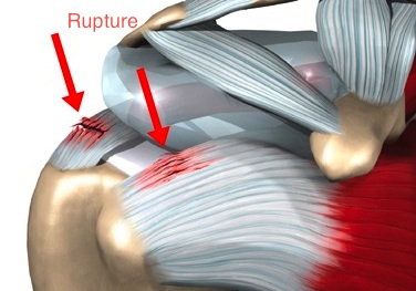 Rupture de la coiffe des rotateurs