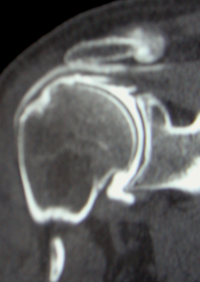 rupture de coiffe