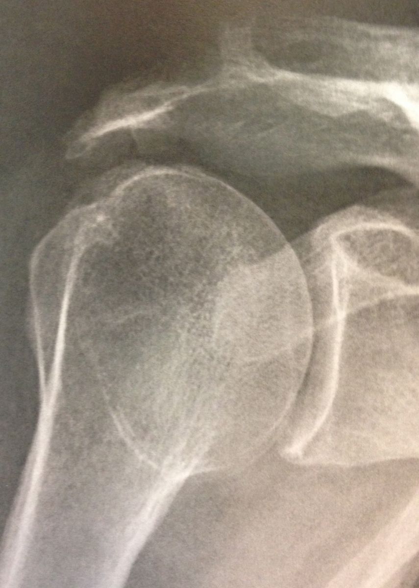 ruptures de la coiffe