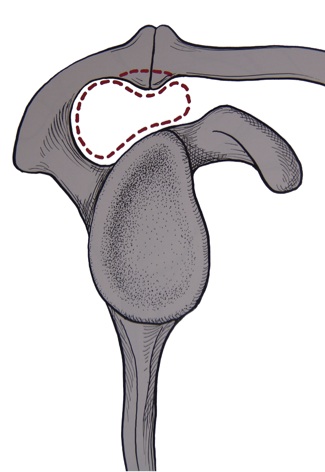 Articulation acromio-claviculaire arthrosique