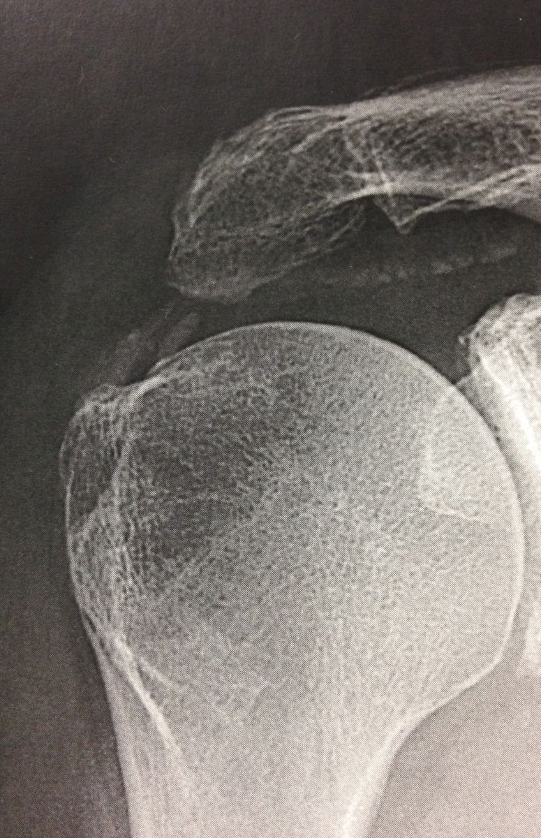 tendinopathie calcifiante