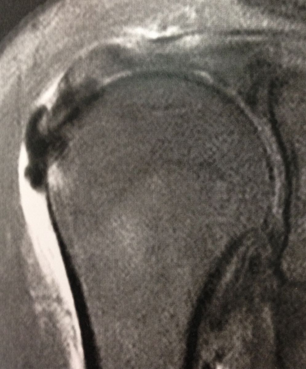 Les tendinopathies calcifiantes