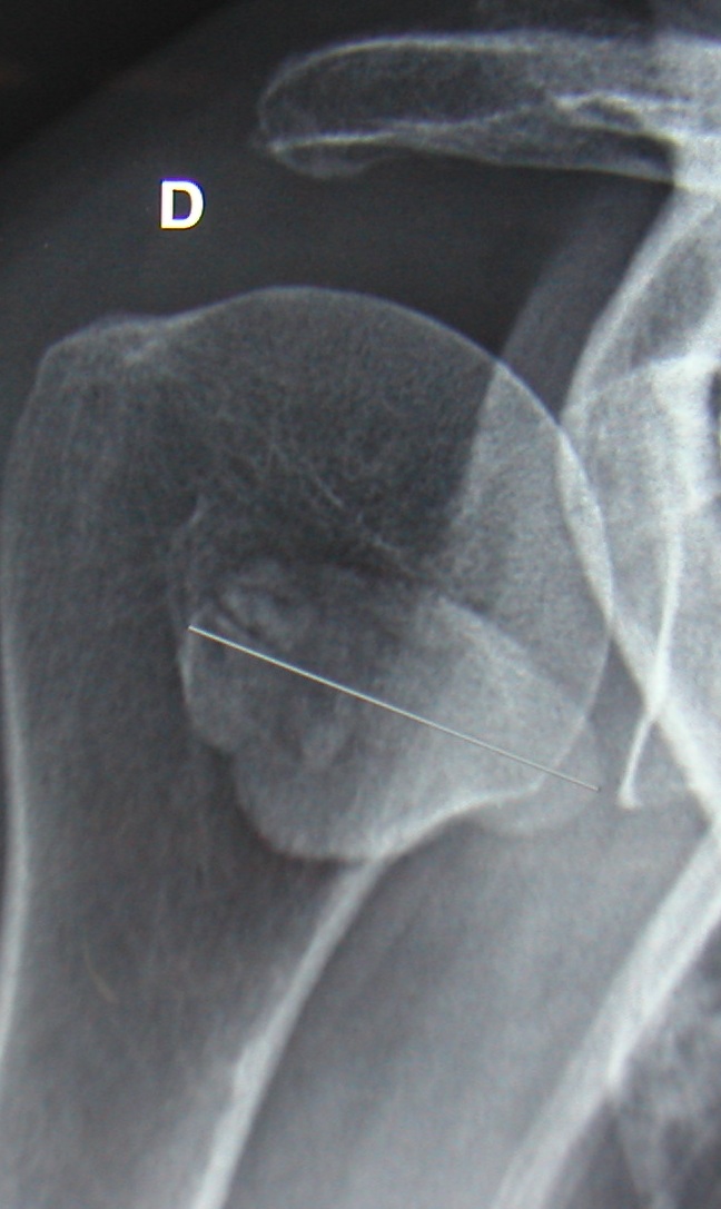 Les tendinopathies calcifiantes