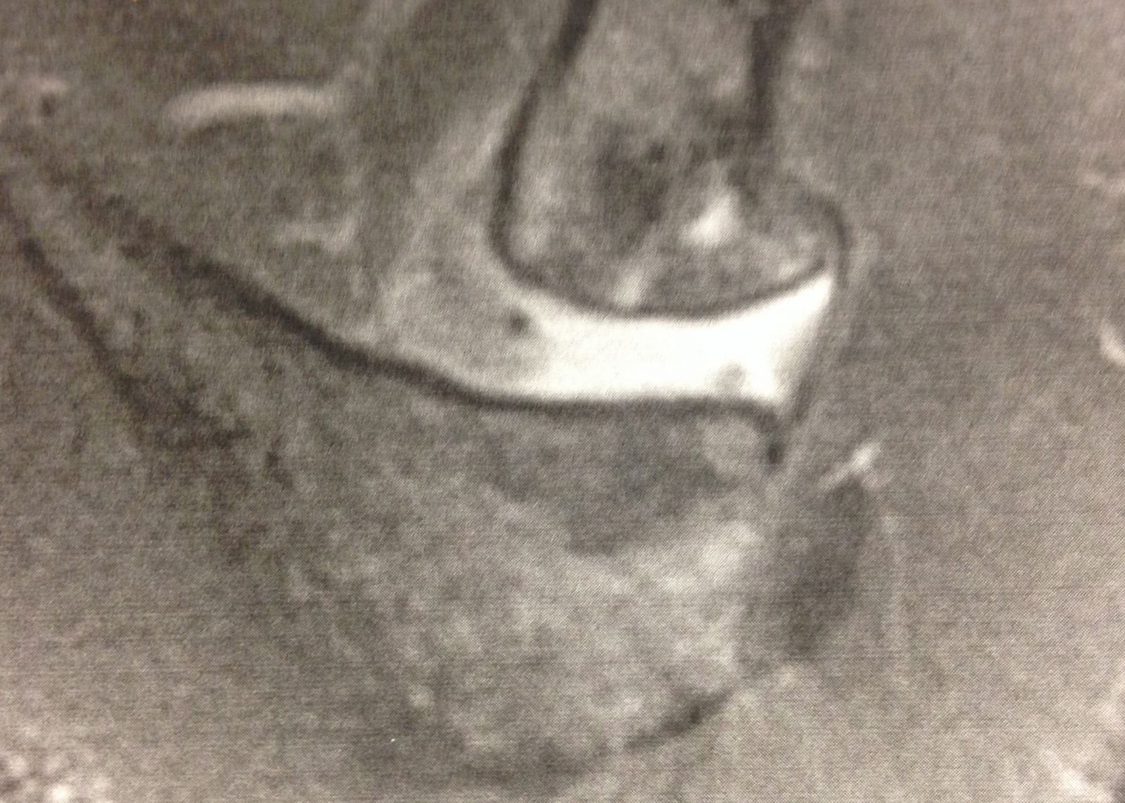 Arthrose acromio-claviculaire