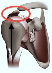 Omarthrose et Prothèse Inversée