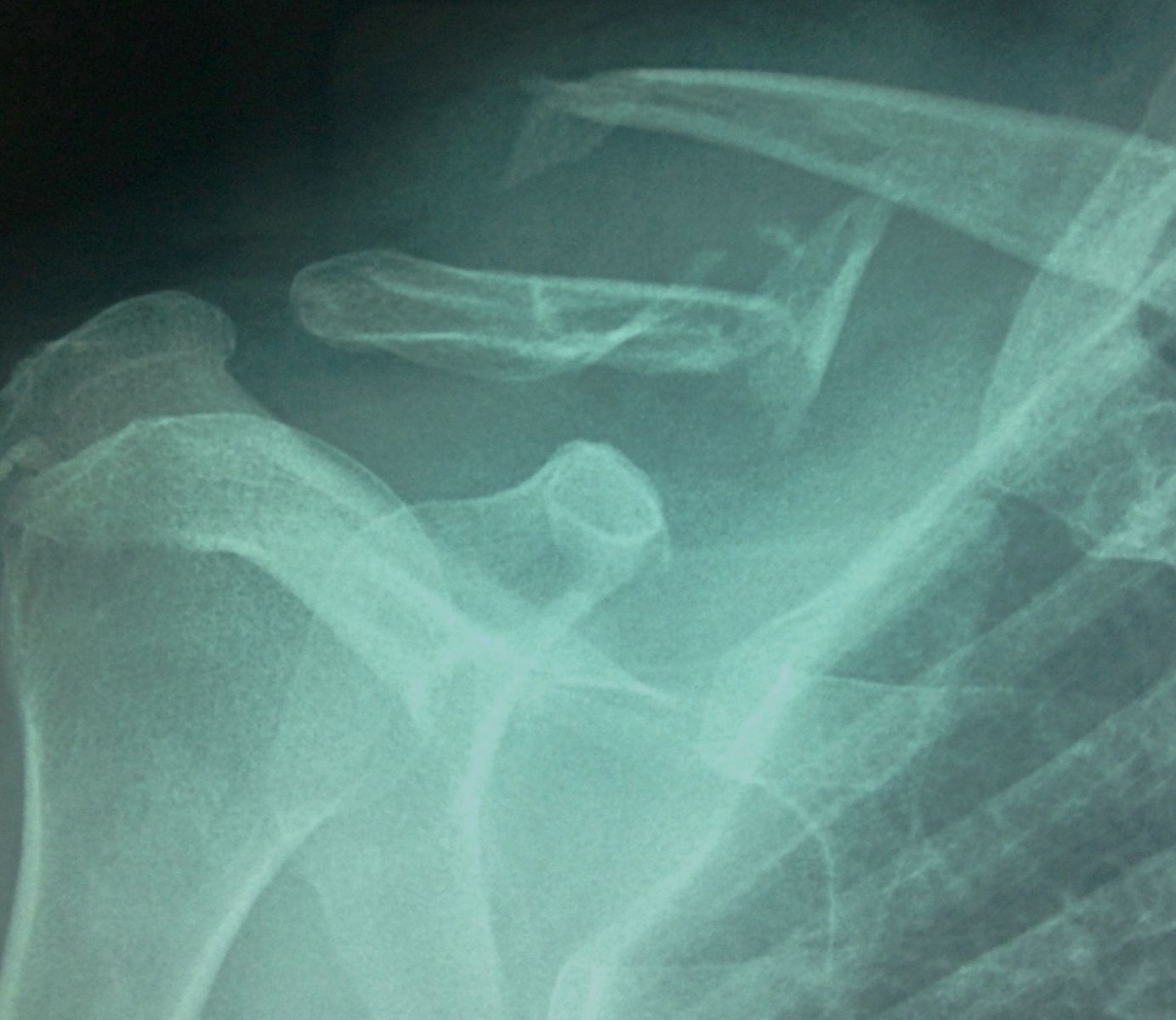 Fracture de la clavicule