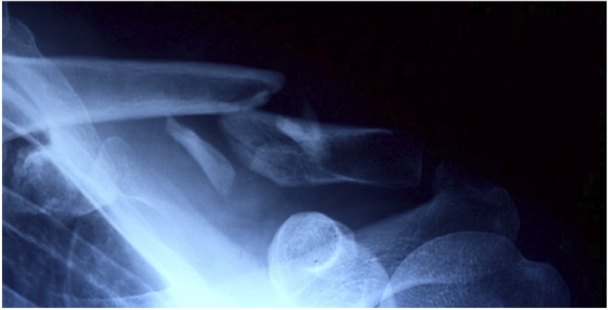 Fracture de la clavicule