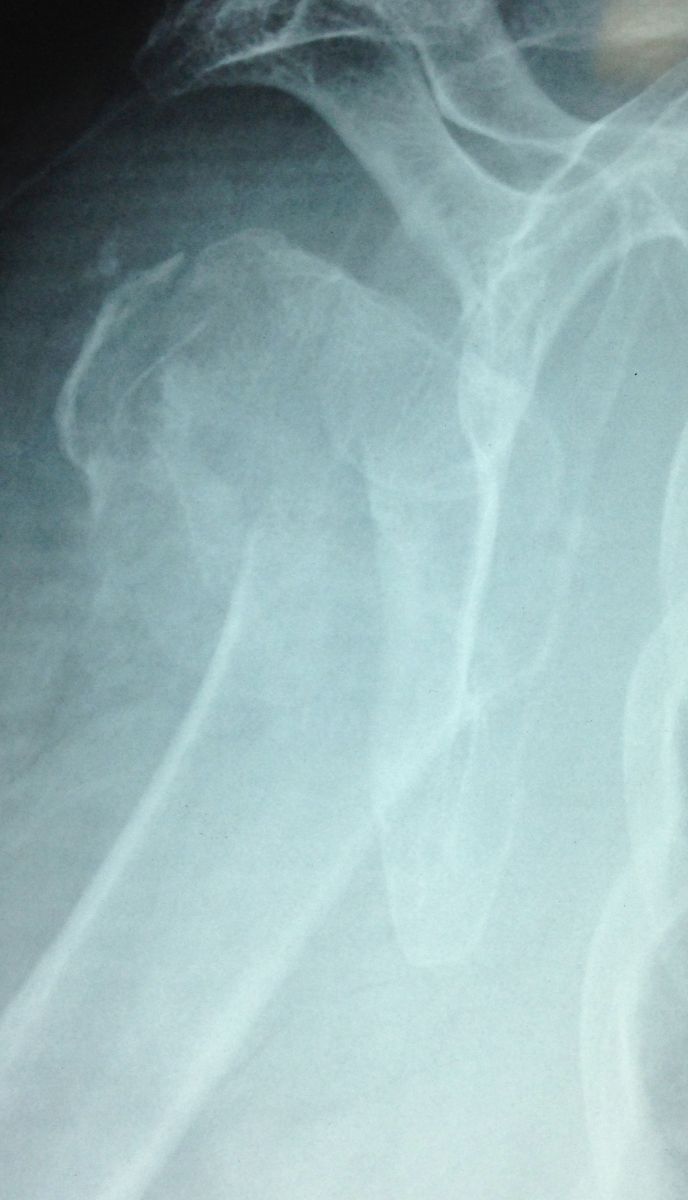 Fracture articulaires de la tête humérale