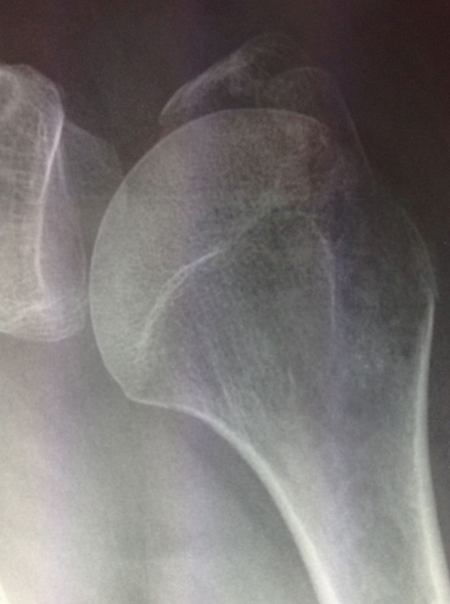 Fracture de l’Humérus