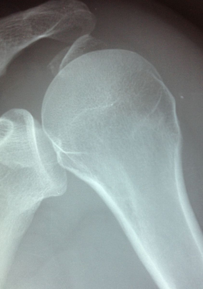 Fracture de l’Humérus