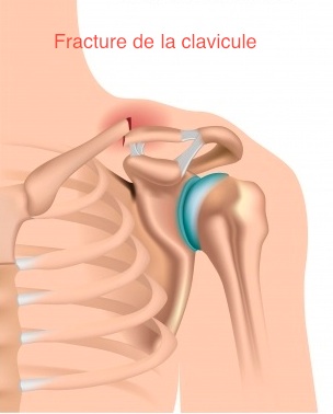 Fractures de la clavicule