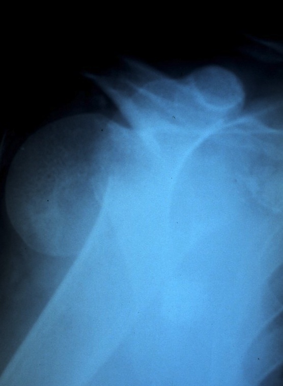 Fractures de la tête humérale
