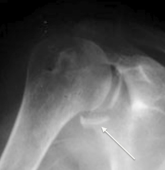 diagnostic Instabilités gléno-humérales