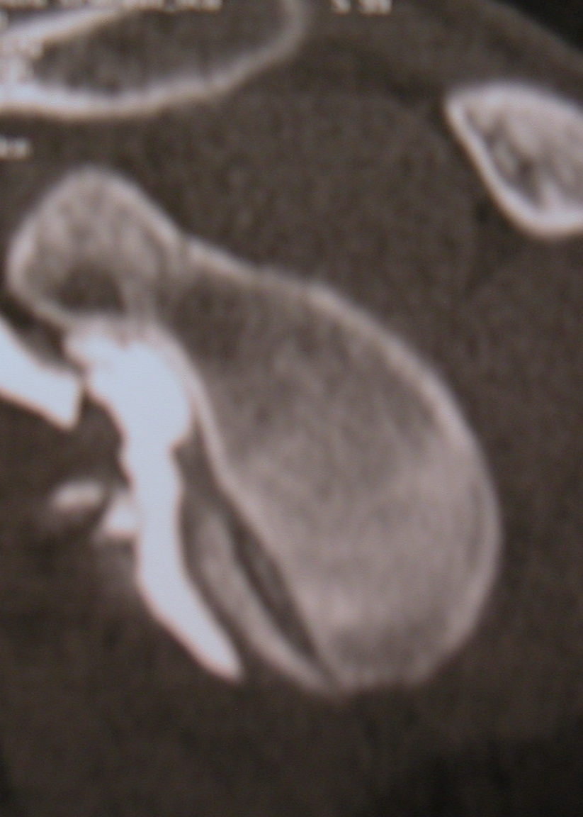 diagnostic Instabilités gléno-humérales