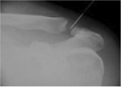 Articulation acromio-claviculaire arthrosique