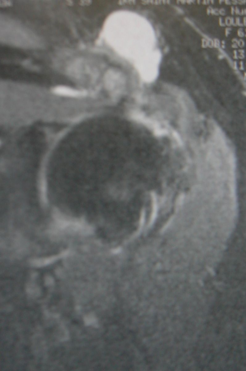 Arthrose acromio-claviculaire