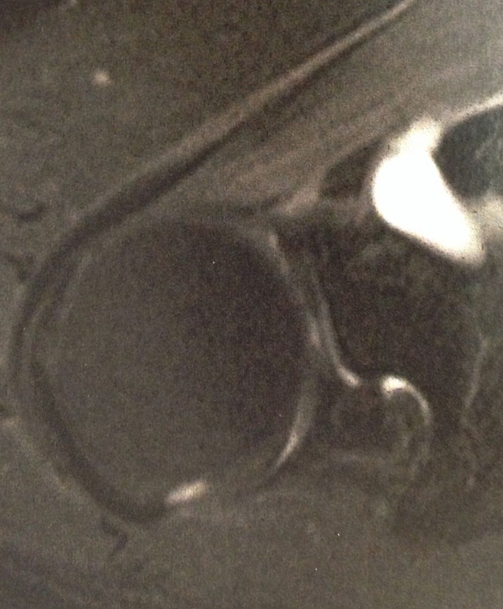 Lésions du nerf Supra scapulaire