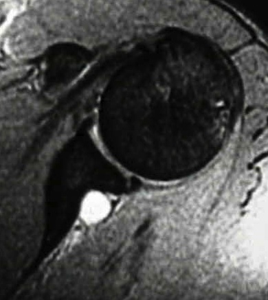 Lésions du nerf Supra scapulaire
