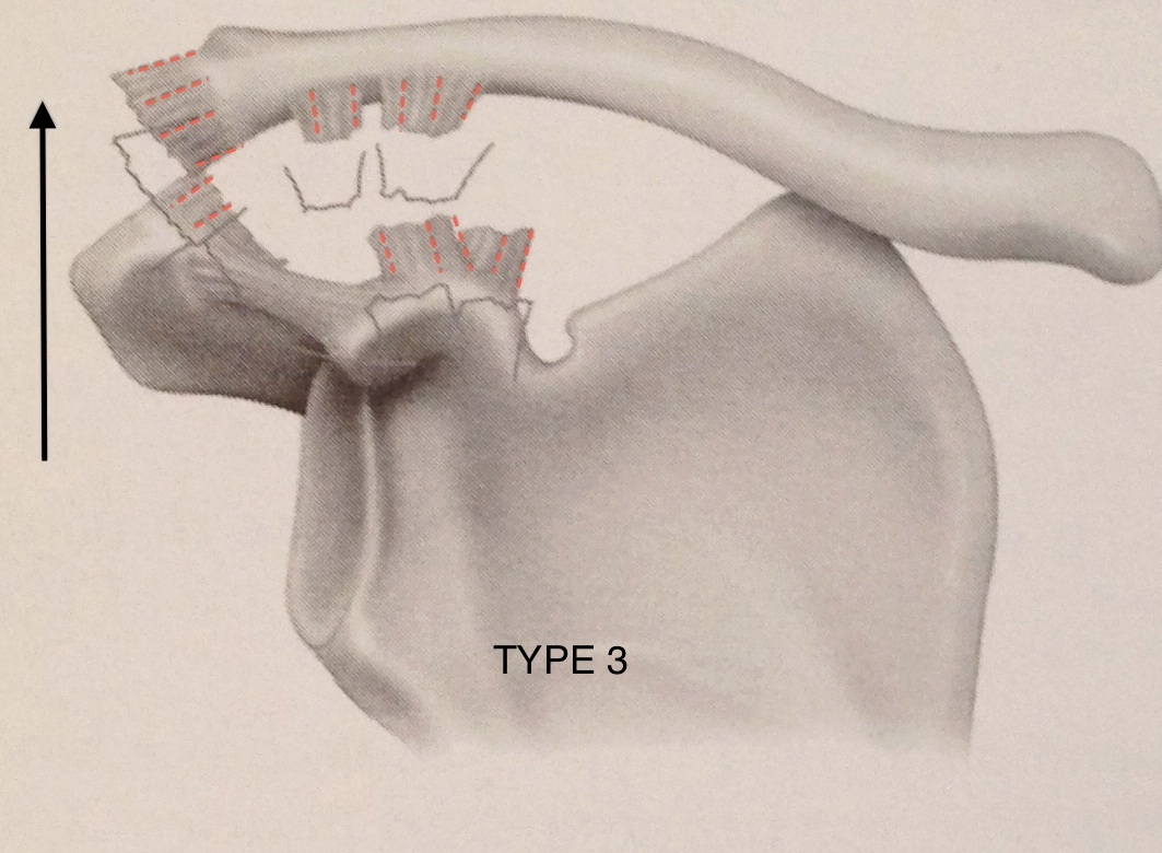 Disjonctions acromio-claviculaires