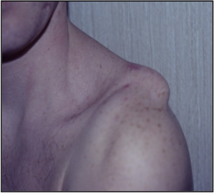 Disjonctions acromio-claviculaires