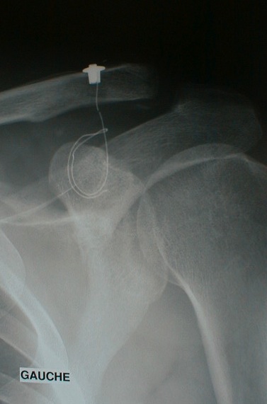 Disjonctions acromio-claviculaires