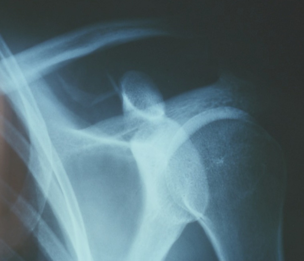 Disjonctions acromio-claviculaires