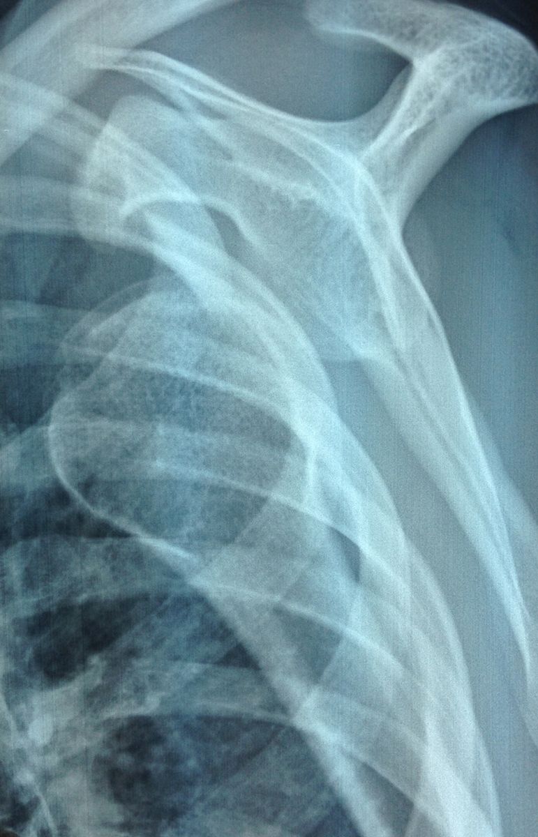diagnostic Instabilités gléno-humérales