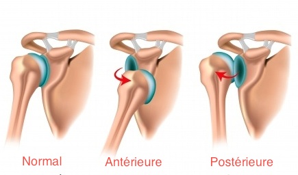 Instabilités gléno-humérales - diagnostic
