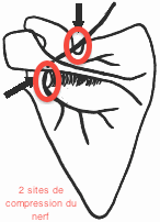 Compressions du nerf Supra scapulaire