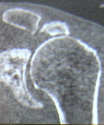 Omarthrose
