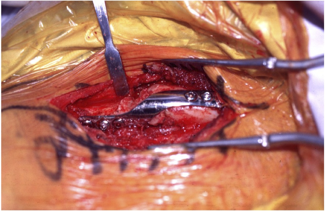 chirurgie Fracture de la clavicule