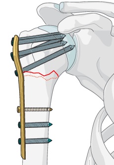 Fractures de l’Humérus