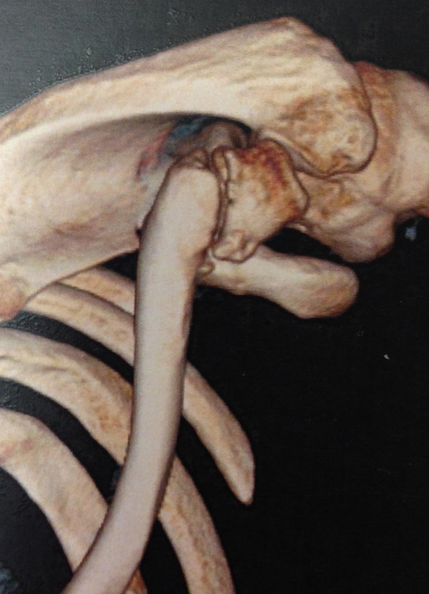 Fractures de la clavicule