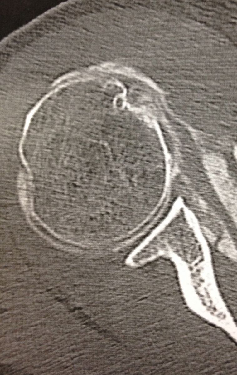 rupture du tendon sub-scapulaire