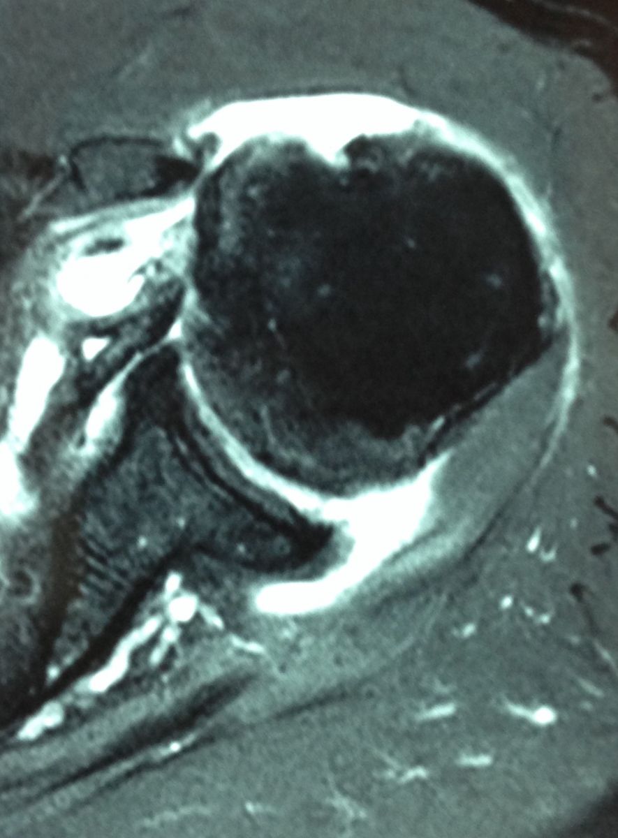 rupture du tendon sub-scapulaire